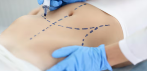 Por Que a Caneta Aspen Cirúrgica é uma das Preferidas em Cirurgias Plásticas