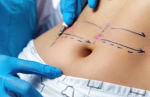 Skin Marker com Ponta Fina ou Grossa: Qual Escolher para Cada Tipo de Marcação